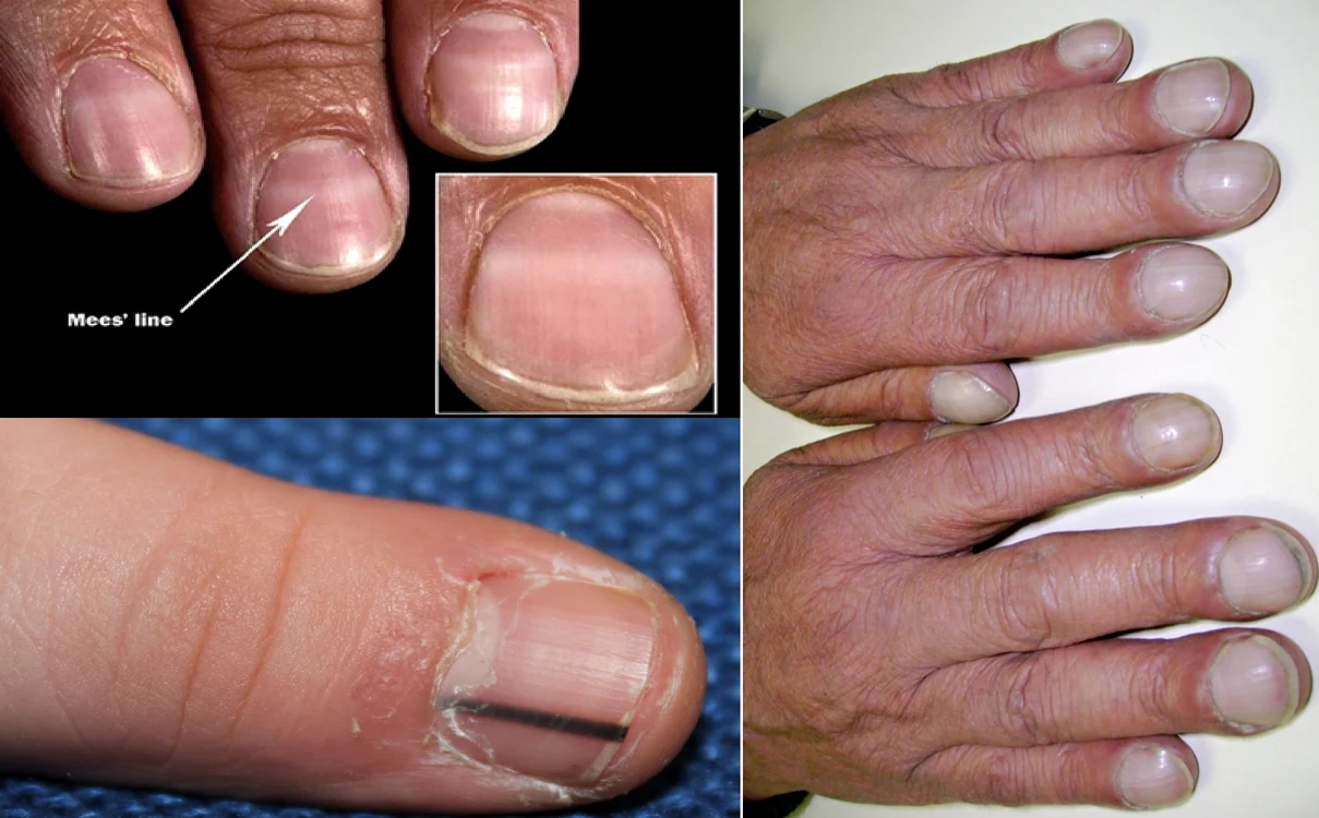 Colaj de imagini cu semnele posibile ale cancerului care apar pe unghii Health&DMS
