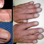 Semnele posibile ale cancerului care apar pe unghii Colaj Health&DMS