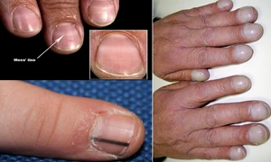 Semnele posibile ale cancerului care apar pe unghii Colaj Health&DMS