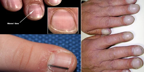Semnele posibile ale cancerului care apar pe unghii Colaj Health&DMS