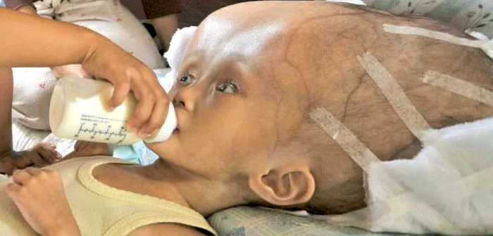 Dilla Anargia Adilla suferă de hidrocefalie, o acumulare anormală de lichid cefalorahidian în cutia craniană