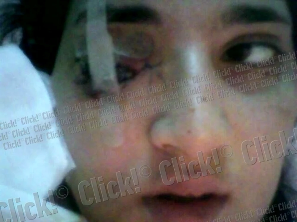 Daniela Borz, tânăra împuşcată în ochi