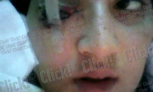 Daniela Borz, tânăra împuşcată în ochi jpeg