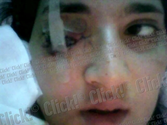 Daniela Borz, tânăra împuşcată în ochi