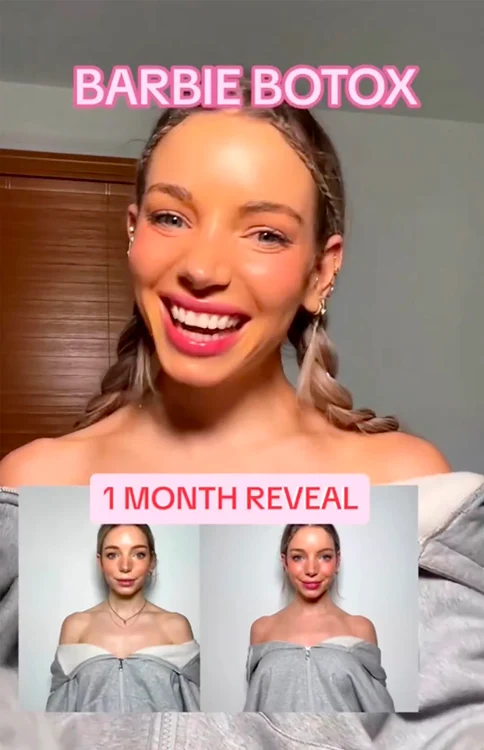 ”Barbie Botox” este la mare căutare în rândul tinerelor, iar pe TikTok a devenit un trend