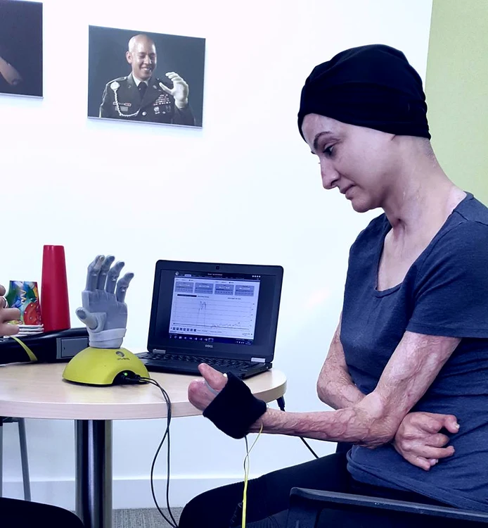 Tedy Ursuleanu a făcut cunoștință cu noua sa mână bionică