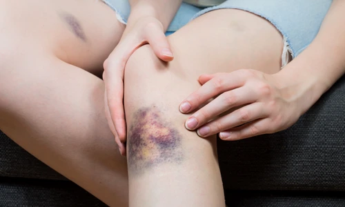 Vânătăi_shutterstock 694634542 jpg