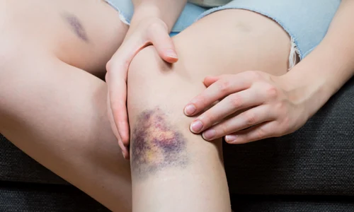 Vânătăi_shutterstock 694634542 jpg