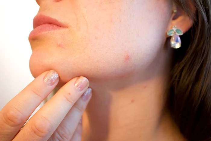 cele mai contagioase boli de piele jpeg