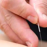 Acupunctură