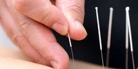 Acupunctură