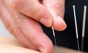 Acupunctură