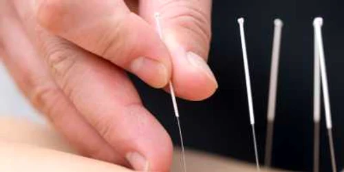 Acupunctură