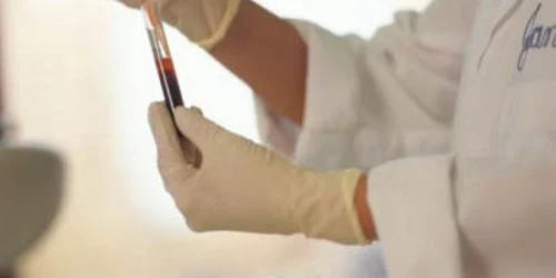 Cancerul de plămân a fost detectat prin analize de sânge în 86% din cazuri 
