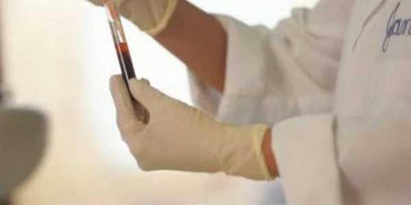 Cancerul de plămân a fost detectat prin analize de sânge în 86% din cazuri 