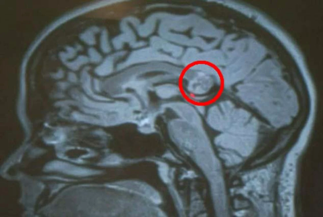 Medicii i-au descoperit în creier un geamăn parazit