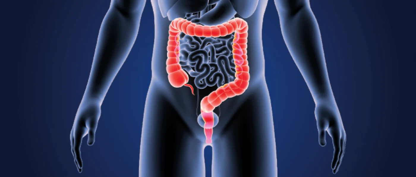 cancer colorectal