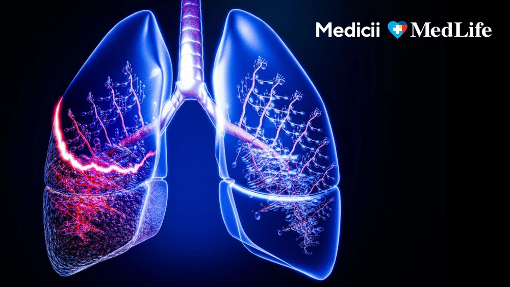 Mesajul Dr. Andrei Dobrea, chirurg toracic, care schimbă lupta cu cancerul pulmonar: „Oricât de rău pare, există soluții”