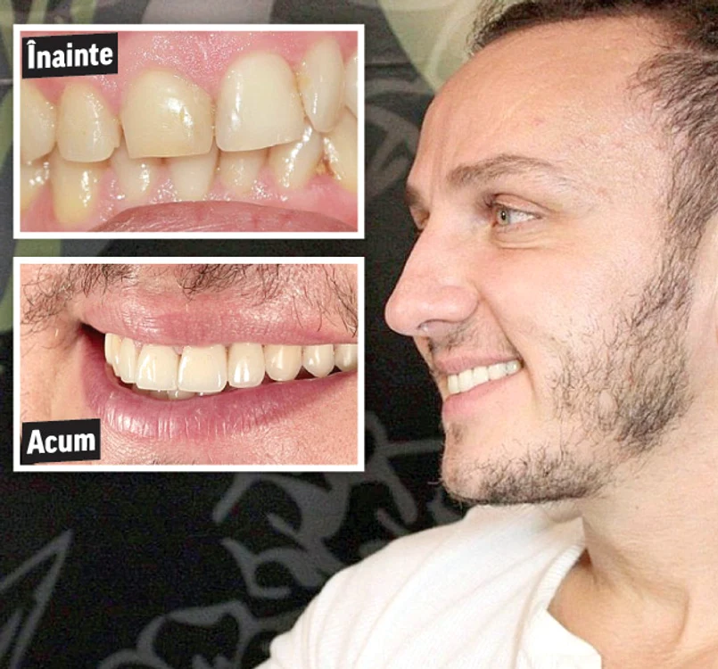 
     Trăistariu şi-a reparat dinţii inesteticiFoto: Arhivă Personală  