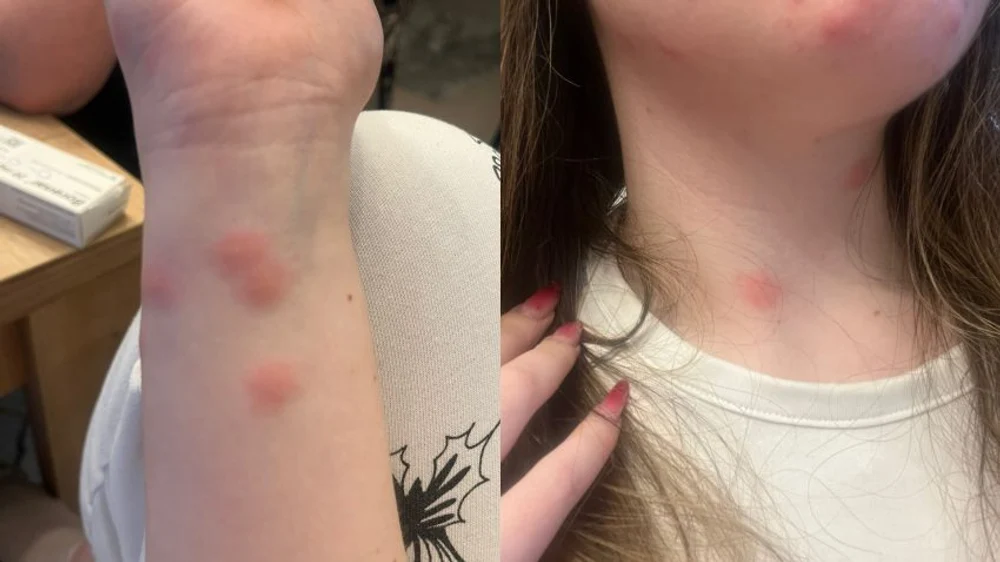 Călătorie de coșmar în trenul CFR: o tânără a ajuns la spital după ce a fost mușcată de ploșnițe