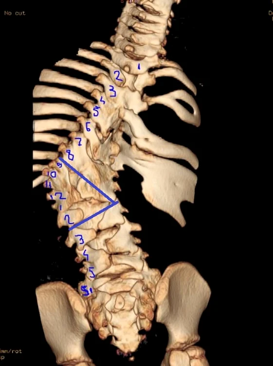 radiografie coloana vertebrala burnei