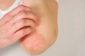 psoriazis jpg