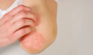 psoriazis jpg