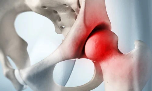 1 boala perthes png png