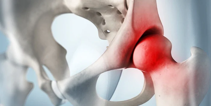 1 boala perthes png png