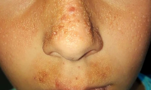 1 pacient diagnosticat cu milium coloid juvenil 2 jpg jpeg