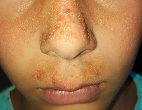 1 pacient diagnosticat cu milium coloid juvenil 2 jpg jpeg