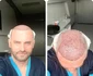 Sorin Brotnei a făcut cel de-al doilea transplant de păr foto: Instagram