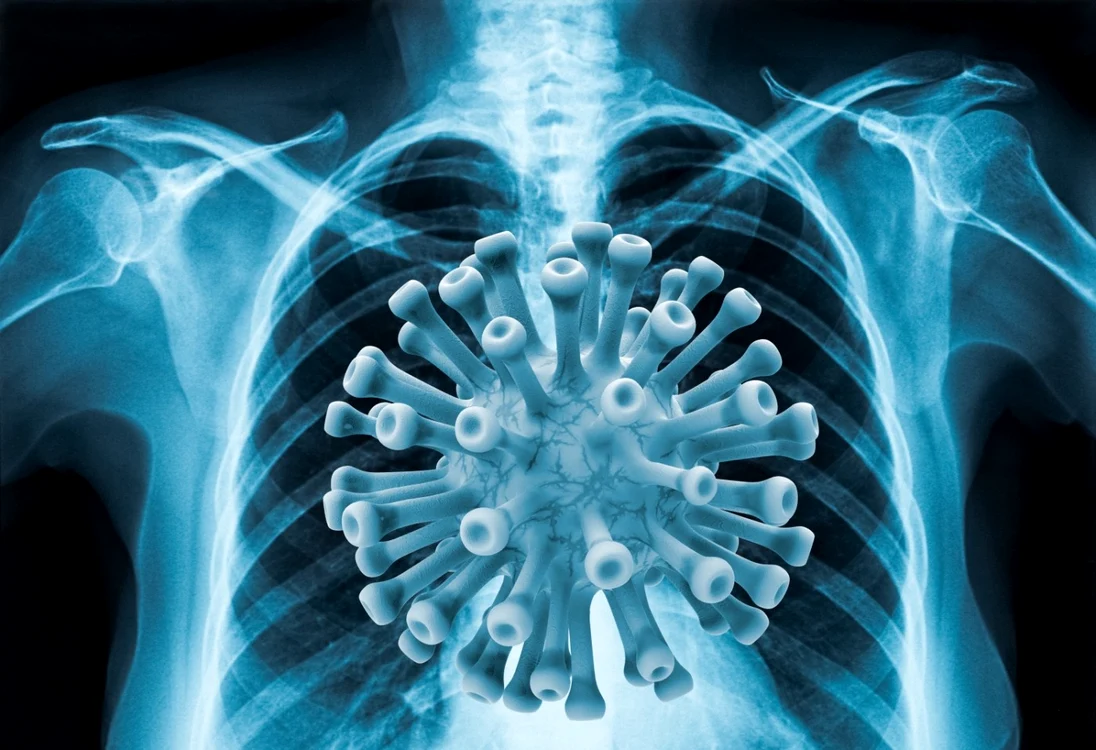 Plămâni infecţie COVID-19 FOTO SHUTTERSTOCK