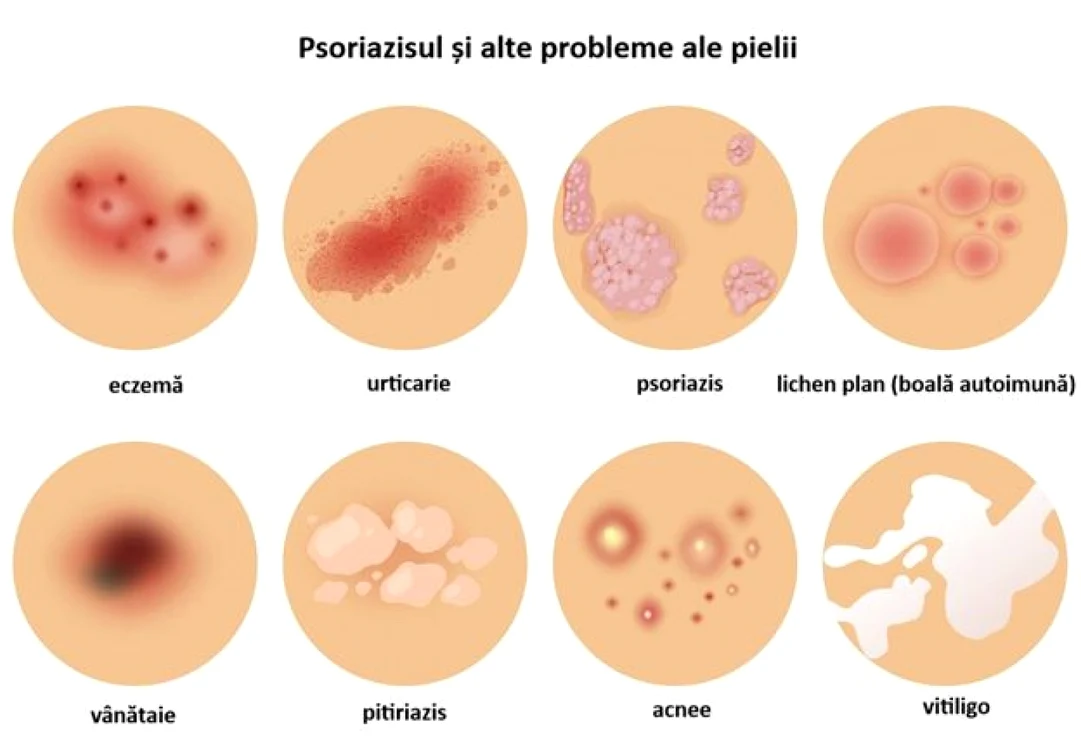 psoriazis şi alte boli de piele