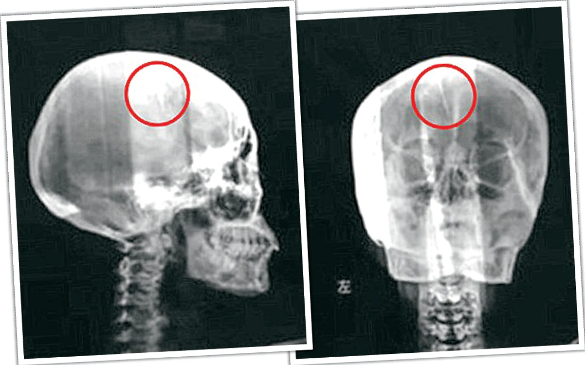 Acul de 4,5 centimetri se află  în emisfera stângă a creierului