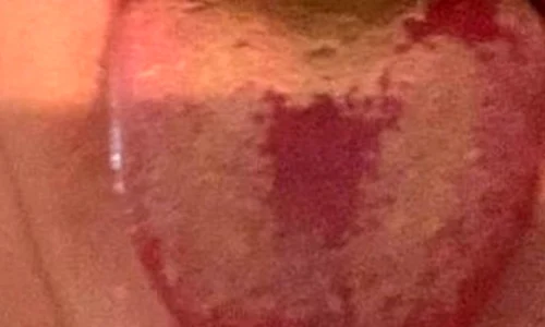 Cel mai nou simptom al infecției cu Covid 19: pete roșii care apar pe limbă, ulcerații la nivelul mucoasei bucale și limba umflată jpeg