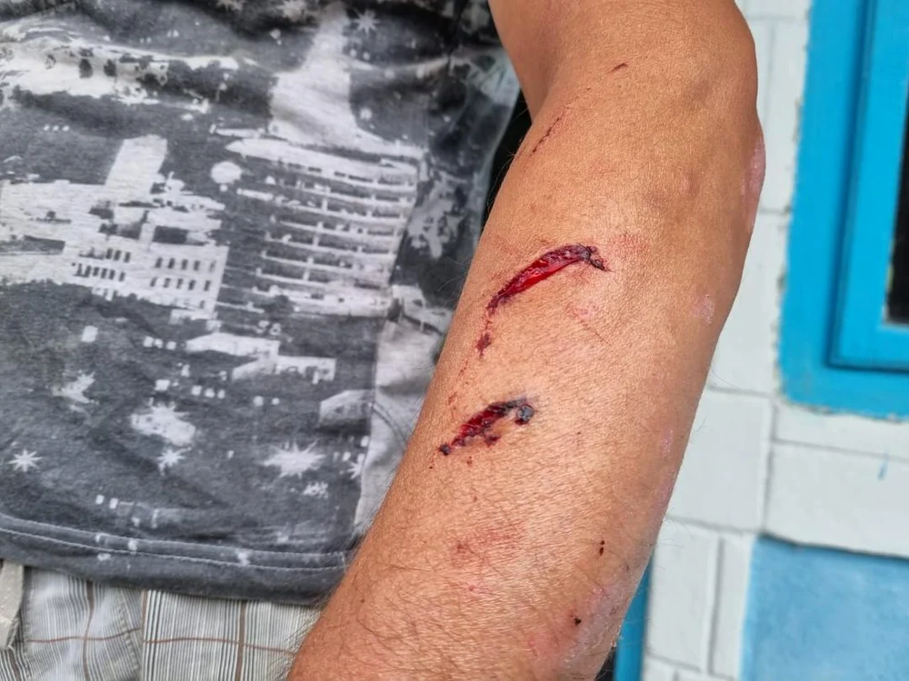 Răni pe antebrațul culegătorului de hribi FOTO Mihai Gontaru