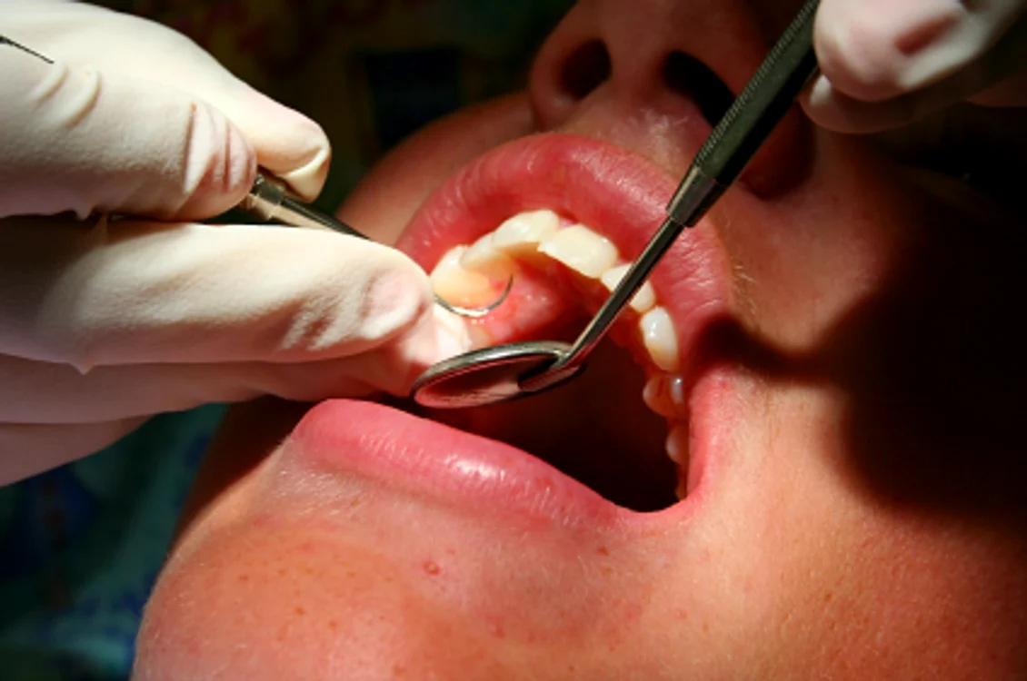 
    Stomatologul la care a mers tânăra prima dată nu era specializat în aplicare faţetelor dentareFoto:dentfix.ro  