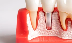 Implant dentar premium   Ce tipuri de implant dentar exista  fb event cover 1920 1005 jpeg