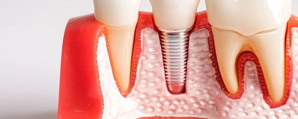 Implant dentar premium   Ce tipuri de implant dentar exista  fb event cover 1920 1005 jpeg