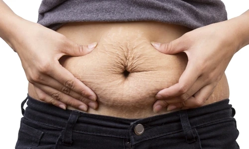 1 burta inestetica dupa nastere jpg jpeg