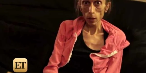 actrita anorexica