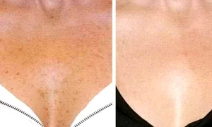 2 cum sa scapi de petele maronii de pe piele jpg jpeg