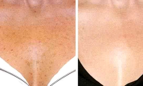 2 cum sa scapi de petele maronii de pe piele jpg jpeg