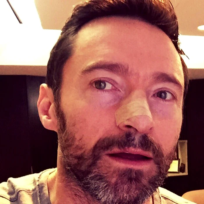Hugh Jackman a fost operat de cancer de piele