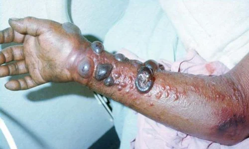 Despre leacurile contra ciumei în cronicile medievale româneşti  «Multe boale şi nevoi grele şi în tot chipul de bube» jpeg