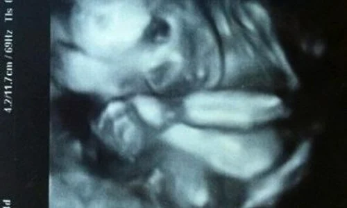 fetus 4 jpeg