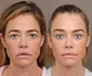 Denise Richards lifting, Foto Instagram