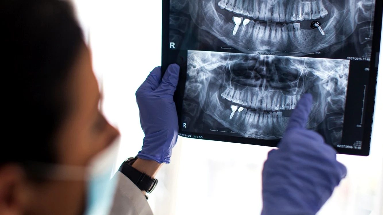 cat dureaza un implant dentar i ce presupune fiecare etapa a tratamentului5 jpg