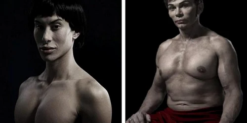 Imaginile deranjante cu oamenii care au suferit operaţii estetice